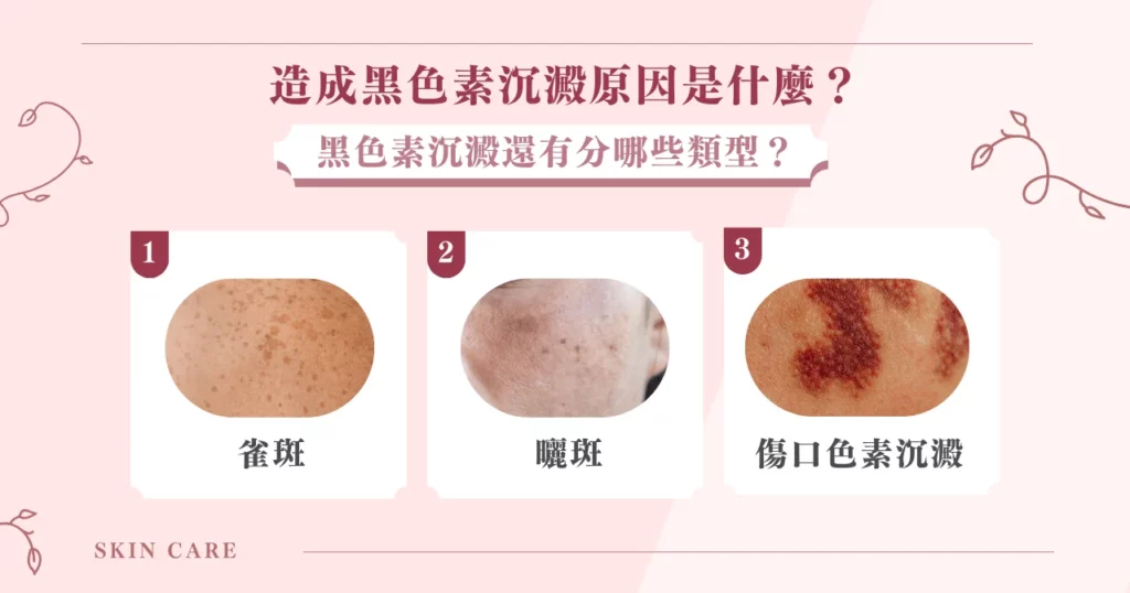 黑色素沉澱原因有 9 種,只要這 6 種狀況就能改善! 4 造成黑色素沉澱原因是什麼?黑色素沉澱還有分哪些類型?