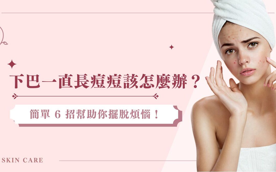 下巴一直長痘痘該怎麼辦?簡單 6 招幫助你擺脫煩惱!