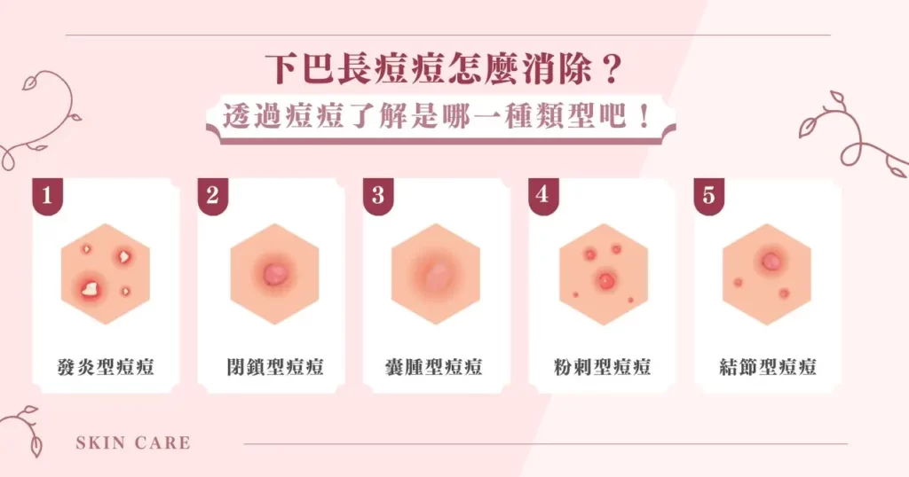 下巴一直長痘痘該怎麼辦?簡單 6 招幫助你擺脫煩惱! 5 下巴長痘痘怎麼消除?透過痘痘了解是哪一種類型吧!