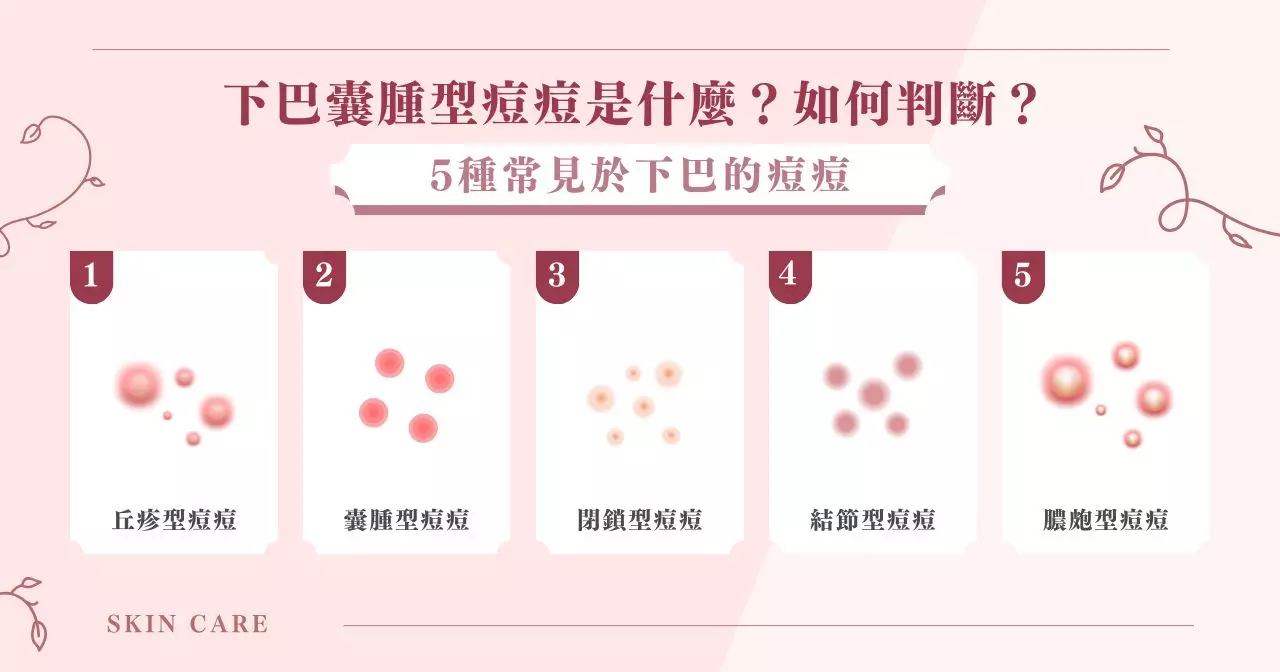 下巴囊腫型痘痘怎麼辦?5 大成因與調理方式一次看! 1 下巴囊腫型痘痘是什麼?如何判斷?5 種常見於下巴的痘痘